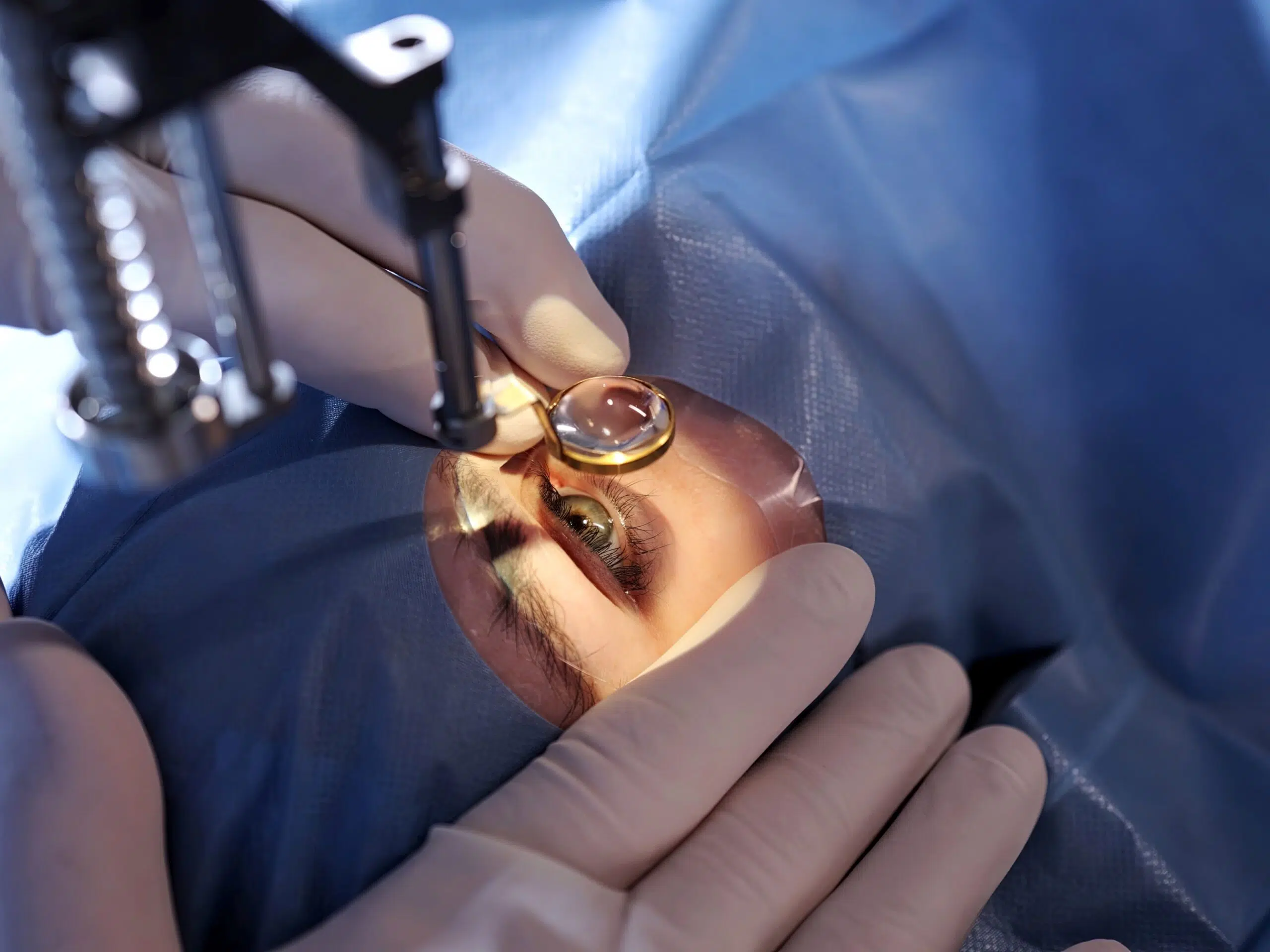 Photo representant un oeil d'un patient avant chirurgie - vitrectomie | Pôle Ophtalmologie normandie - Barentin